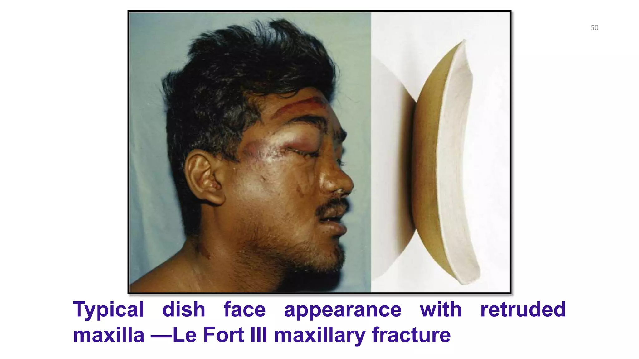 50
Typical dish face appearance with retruded
maxilla —Le Fort III maxillary fracture
 