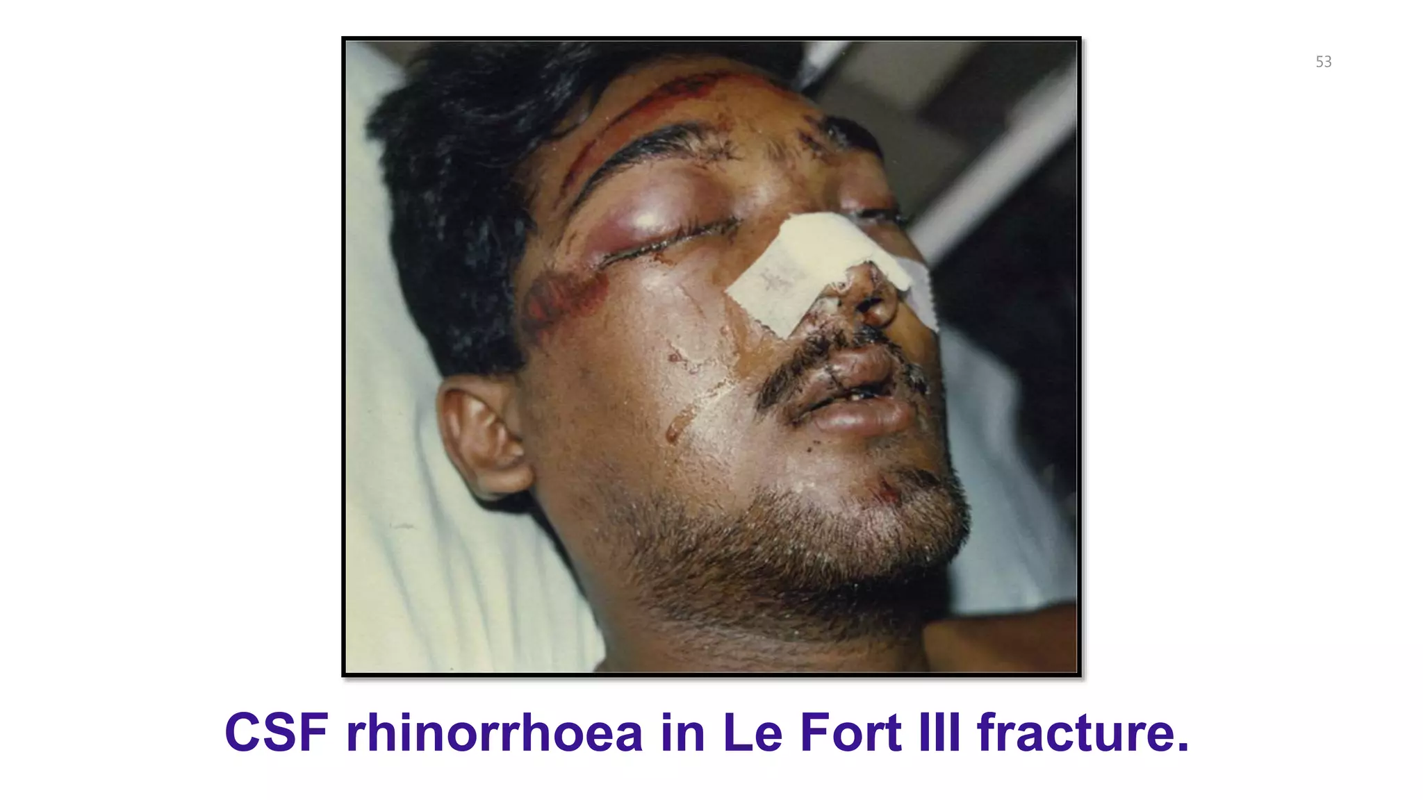 53
CSF rhinorrhoea in Le Fort III fracture.
 