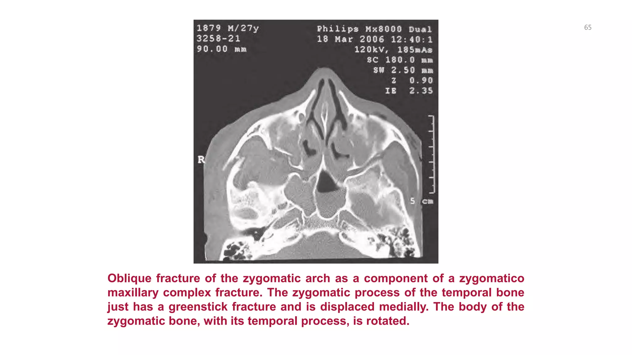 65
Oblique fracture of the zygomatic arch as a component of a zygomatico
maxillary complex fracture. The zygomatic process of the temporal bone
just has a greenstick fracture and is displaced medially. The body of the
zygomatic bone, with its temporal process, is rotated.
 