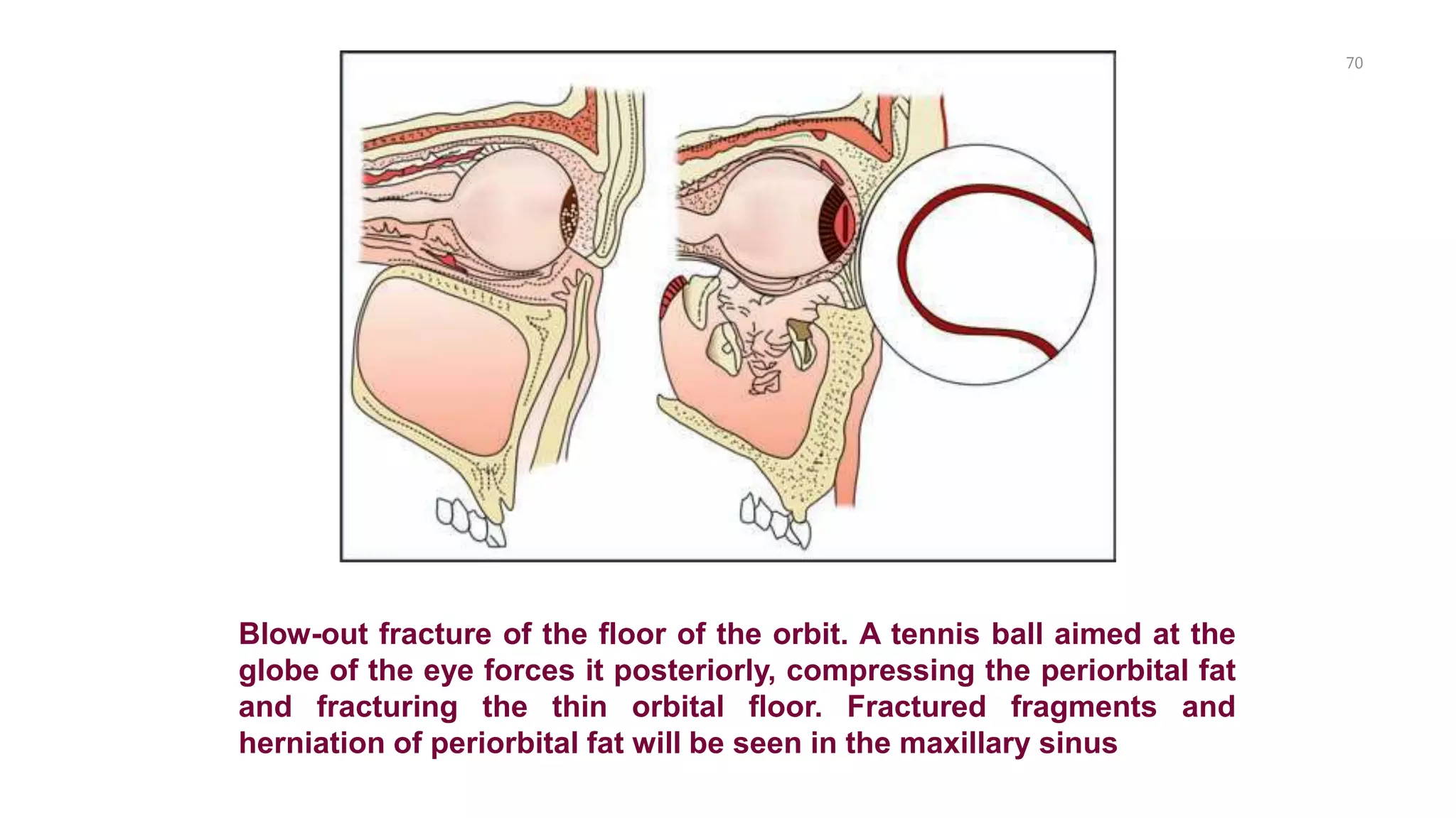 70
Blow-out fracture of the floor of the orbit. A tennis ball aimed at the
globe of the eye forces it posteriorly, compressing the periorbital fat
and fracturing the thin orbital floor. Fractured fragments and
herniation of periorbital fat will be seen in the maxillary sinus
 
