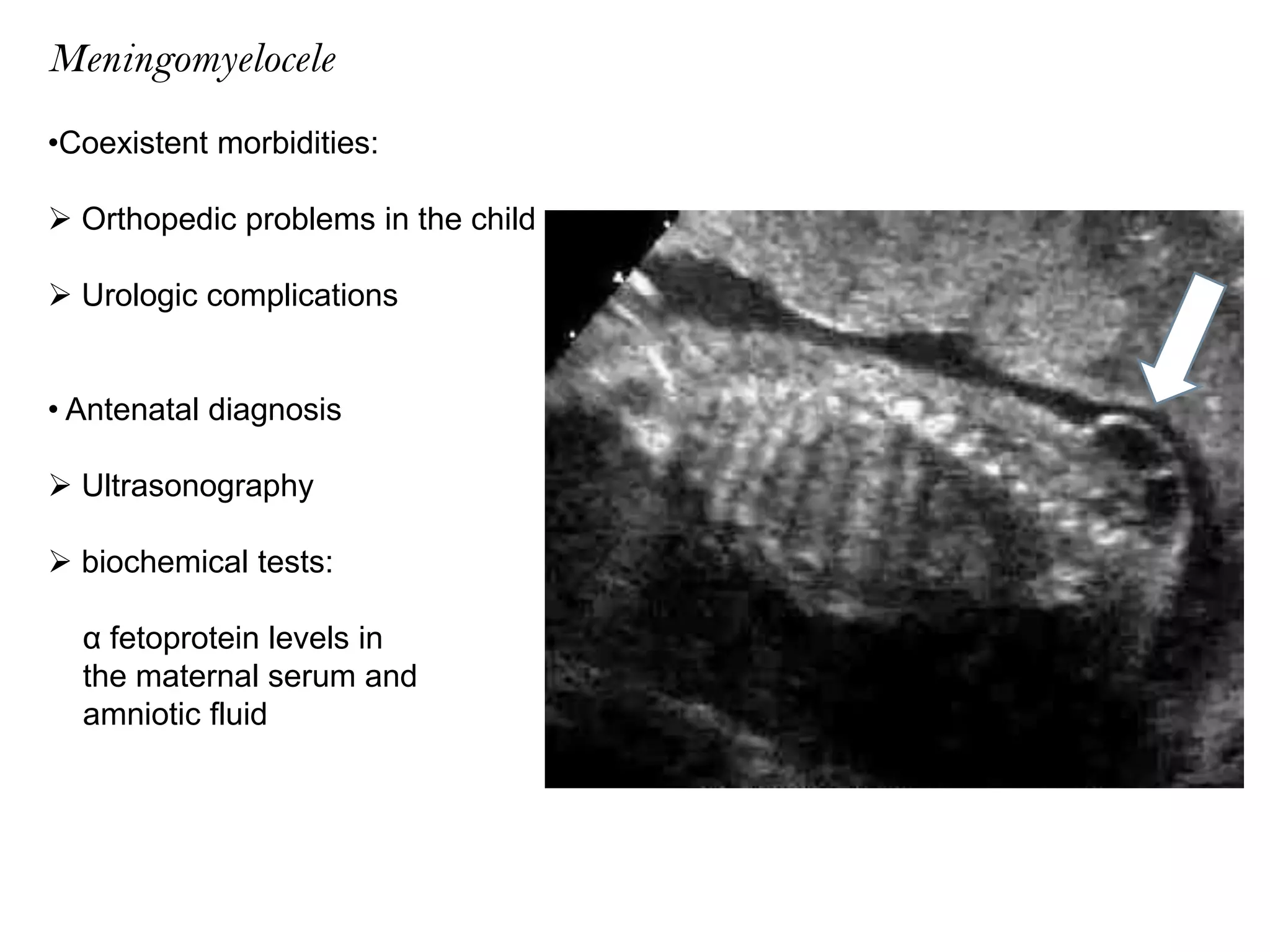 Meningomyelocele and Anesthesia | PPTX