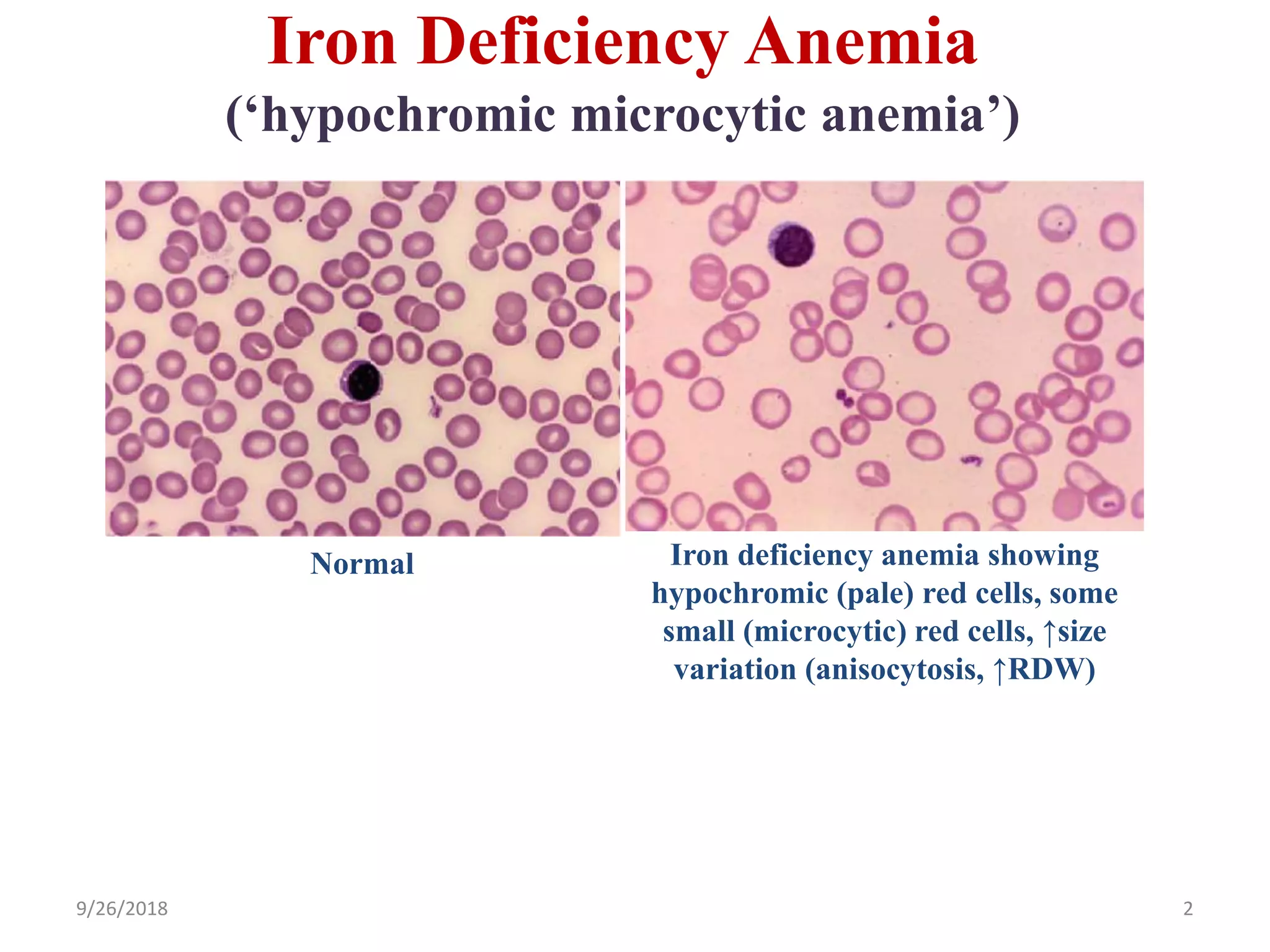 Iron Deficiency Anemia
(‘hypochromic microcytic anemia’)
9/26/2018 2
Normal Iron deficiency anemia showing
hypochromic (pale) red cells, some
small (microcytic) red cells, ↑size
variation (anisocytosis, ↑RDW)
 