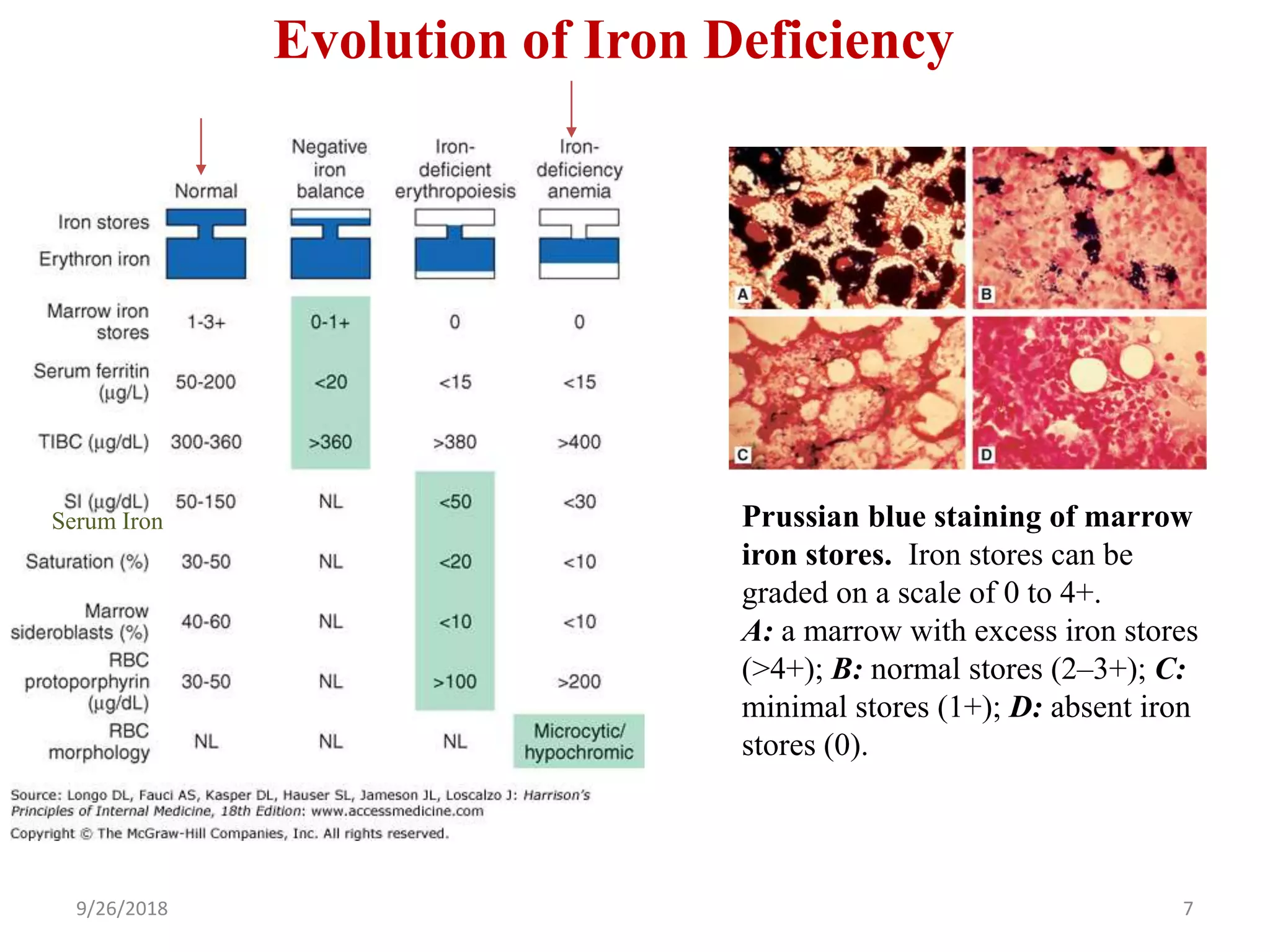Evolution of Iron Deficiency
9/26/2018 7
Prussian blue staining of marrow
iron stores. Iron stores can be
graded on a scale of 0 to 4+.
A: a marrow with excess iron stores
(>4+); B: normal stores (2–3+); C:
minimal stores (1+); D: absent iron
stores (0).
Serum Iron
 