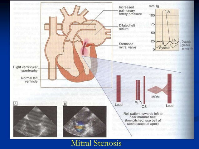 2 MITRAL VALVE DISEASE.ppt | Heart and Cardiovascular Diseases ...