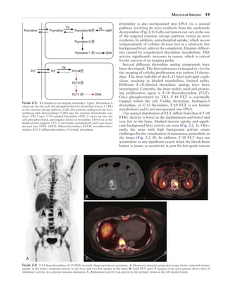 Molecular Imaging 19 
thymidine is also incorporated into DNA via a second 
pathway involving de novo synthesis from the nucleotide 
deoxyuridine (Fig. 2-1). Cells and tumors can vary in the use 
of the targeted extrinsic salvage pathway versus de novo 
synthesis. In addition, mitochondrial uptake, which occurs 
independently of cellular division but at a relatively low 
background level, adds to the complexity. Despite difficul-ties 
caused by complicated thymidine metabolism, TK1 
activity significantly increases in cancer, which is critical 
for the success of an imaging probe. 
Several different thymidine analog compounds have 
been developed. The first radiotracer evaluated in vivo for 
the imaging of cellular proliferation was carbon-11 thymi-dine. 
The short half-life of the C-11 label and rapid catab-olism, 
resulting in labeled metabolites, limited utility. 
Different F-18–labeled thymidine analogs have been 
investigated. Currently, the most widely used and promis-ing 
proliferation agent is F-18 fluorothymidine (FLT). 
Once phosphorylated by TK1, F-18 FLT is essentially 
trapped within the cell. Unlike thymidine, hydrogen-3 
thymidine, or C-11 thymidine, F-18 FLT is not further 
metabolized and is not incorporated into DNA. 
The normal distribution of FLT differs from that of F-18 
FDG. Activity is lower in the mediastinum and bowel and 
very low in the brain. Marked marrow uptake and signifi-cant 
background liver activity are seen (Fig. 2-2, A). Obvi-ously, 
the areas with high background activity create 
challenges for the visualization of metastases, particularly in 
the bones (Fig. 2-2, B). In addition, F-18 FLT does not 
accumulate to any significant extent when the blood–brain 
barrier is intact, so sensitivity is poor for low-grade tumors 
Thymidine 
TK 
Thymidine 
TK 
TS 
Thymidine M UMP 
Thymidine D 
Thymidine T 
P 
P 
P 
FLT-M 
FLT-D 
FLT-T 
P 
P 
P 
DNA 
FLT FLT 
DNA 
Figure 2-1. Thymidine as an imaging biomarker. Upper, Thymidine is 
taken up into the cell and phosphorylated by thymidine kinase 1 (TK) 
in the external salvage pathway. Cells also perform endogenous de novo 
synthesis with deoxyuridine (UMP) and the enzyme thymidylate syn-thase 
(TS). Lower, F-18–labeled thymidine (FLT) is taken up into the 
cell, phosphorylated, and trapped similar to thymidine. However, as the 
dashed arrows suggest, FLT is not further metabolized and is not incor-porated 
into DNA. FLT-D, difluorothymidine; FLT-M, monofluorothy-midine; 
FLT-T, trifluorothymidine; P (circled), phosphate. 
A 
B 
C 
Figure 2-2. F-18 fluorothymidine (F-18 FLT) in newly diagnosed breast carcinoma. A, Maximum intensity projection image shows expected intense 
uptake in the bones, moderate activity in the liver, and very low uptake in the brain. B, Axial PET and CT images in the same patient show a lack of 
radiotracer activity in a sclerotic osseous metastasis. C, Radiotracer activity was present in the primary tumor in the left medial breast. 
 