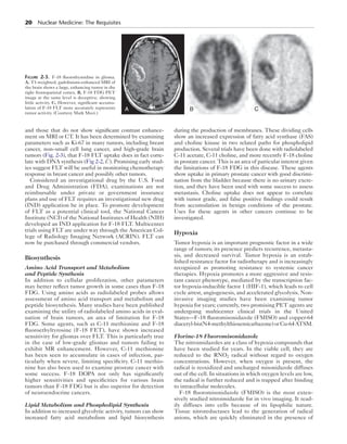 20 Nuclear Medicine: The Requisites 
and those that do not show significant contrast enhance-ment 
on MRI or CT. It has been determined by examining 
parameters such as Ki-67 in many tumors, including breast 
cancer, non–small cell lung cancer, and high-grade brain 
tumors (Fig. 2-3), that F-18 FLT uptake does in fact corre-late 
with DNA synthesis (Fig 2-2, C ). Promising early stud-ies 
suggest FLT will be useful in monitoring chemotherapy 
response in breast cancer and possibly other tumors. 
Considered an investigational drug by the U.S. Food 
and Drug Administration (FDA), examinations are not 
reimbursable under private or government insurance 
plans and use of FLT requires an investigational new drug 
(IND) application be in place. To promote development 
of FLT as a potential clinical tool, the National Cancer 
Institute (NCI) of the National Institutes of Health (NIH) 
developed an IND application for F-18 FLT. Multicenter 
trials using FLT are under way through the American Col-lege 
of Radiology Imaging Network (ACRIN). FLT can 
now be purchased through commercial vendors. 
Biosynthesis 
Amino Acid Transport and Metabolism 
and Peptide Synthesis 
In addition to cellular proliferation, other parameters 
may better reflect tumor growth in some cases than F-18 
FDG. Using amino acids as radiolabeled probes allows 
assessment of amino acid transport and metabolism and 
peptide biosynthesis. Many studies have been published 
examining the utility of radiolabeled amino acids in eval-uation 
of brain tumors, an area of limitation for F-18 
FDG. Some agents, such as C-11 methionine and F-18 
fluoroethyltyrosine (F-18 FET), have shown increased 
sensitivity for gliomas over FLT. This is particularly true 
in the case of low-grade gliomas and tumors failing to 
exhibit MR enhancement. However, C-11 methionine 
has been seen to accumulate in cases of infection, par-ticularly 
when severe, limiting specificity. C-11 methio-nine 
has also been used to examine prostate cancer with 
some success. F-18 DOPA not only has significantly 
higher sensitivities and specificities for various brain 
tumors than F-18 FDG but is also superior for detection 
of neuroendocrine cancers. 
Lipid Metabolism and Phospholipid Synthesis 
In addition to increased glycolytic activity, tumors can show 
increased fatty acid metabolism and lipid biosynthesis 
during the production of membranes. These dividing cells 
show an increased expression of fatty acid synthase (FAS) 
and choline kinase in two related paths for phospholipid 
production. Several trials have been done with radiolabeled 
C-11 acetate, C-11 choline, and more recently F-18 choline 
in prostate cancer. This is an area of particular interest given 
the limitations of F-18 FDG in this disease. These agents 
show uptake in primary prostate cancer with good discrimi-nation 
from the bladder because there is no urinary excre-tion, 
and they have been used with some success to assess 
metastasis. Choline uptake does not appear to correlate 
with tumor grade, and false positive findings could result 
from accumulation in benign conditions of the prostate. 
Uses for these agents in other cancers continue to be 
investigated. 
Hypoxia 
Tumor hypoxia is an important prognostic factor in a wide 
range of tumors; its presence predicts recurrence, metasta-sis, 
and decreased survival. Tumor hypoxia is an estab-lished 
resistance factor for radiotherapy and is increasingly 
recognized as promoting resistance to systemic cancer 
therapies. Hypoxia promotes a more aggressive and resis-tant 
cancer phenotype, mediated by the transcription fac-tor 
hypoxia-inducible factor 1 (HIF-1), which leads to cell 
cycle arrest, angiogenesis, and accelerated glycolysis. Non-invasive 
imaging studies have been examining tumor 
hypoxia for years; currently, two promising PET agents are 
undergoing multicenter clinical trials in the United 
States—F-18 fluoromisonidazole (FMISO) and copper-64 
diacetyl-bis(N4-methylthiosemicarbazone) or Cu-64 ATSM. 
Florine-18 Fluoromisonidazole 
The nitroimidazoles are a class of hypoxia compounds that 
have been studied for years. In the viable cell, they are 
reduced to the RNO2 radical without regard to oxygen 
concentrations. However, when oxygen is present, the 
radical is reoxidized and uncharged misonidazole diffuses 
out of the cell. In situations in which oxygen levels are low, 
the radical is further reduced and is trapped after binding 
to intracellular molecules. 
F-18 fluoromisonidazole (FMISO) is the most exten-sively 
studied nitroimidazole for in vivo imaging. It read-ily 
diffuses into cells because of its lipophilic nature. 
Tissue nitroreductases lead to the generation of radical 
anions, which are quickly eliminated in the presence of 
Figure 2-3. F-18 fluorothymidine in glioma. 
A, T1-weighted, gadolinium-enhanced MRI of 
the brain shows a large, enhancing tumor in the 
right frontoparietal cortex. B, F-18 FDG PET 
image at the same level is deceptive, showing 
little activity. C, However, significant accumu-lation 
of F-18 FLT more accurately represents 
tumor activity. (Courtesy Mark Muzi.) 
A B C 
 