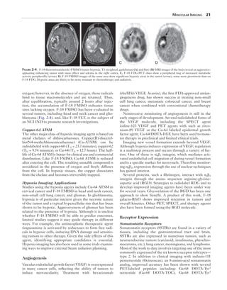Molecular Imaging 21 
A B C D 
Figure 2-4. F-18 fluoromisonidazole (FMISO) tumor hypoxia. T1-weighted, gadolinium (A) and flare (B) MRI images of the brain reveal an aggressive-appearing 
enhancing tumor with mass effect and edema in the right cortex. C, F-18 FDG PET does show a peripheral ring of increased metabolic 
activity peripherally (arrow). D, F-18 FMISO images of the same area show significant hypoxic areas in the tumor (arrow), some more prominent than on 
F-18 FDG. Hypoxic areas are likely to be more resistant to chemotherapy and radiation. 
oxygen; however, in the absence of oxygen, these radicals 
bind to tissue macromolecules and are retained. Thus, 
after equilibration, typically around 2 hours after injec-tion, 
the accumulation of F-18 FMISO indicates tissue 
sites lacking oxygen. F-18 FMISO has been evaluated in 
several tumors, including head and neck cancer and glio-blastoma 
(Fig. 2-4), and, like F-18 FLT, is the subject of 
an NCI IND to promote research investigations. 
Copper-64 ATSM 
The other major class of hypoxia imaging agent is based on 
metal chelates of dithiocarbazones. Copper(II)-diacetyl-bis( 
N4-methylthiosemicarbazone) (Cu-ATSM) can be 
radio­labeled 
with copper-60 (T½ = 23.7 minutes), copper-62 
(T½ = 9.74 minutes), or Cu-64 (T½ = 12.7 hours). The half-life 
of Cu-64 ATSM is better for clinical use and commercial 
distribution. Like F-18 FMISO, Cu-64 ATSM is reduced 
after entering the cell. The resulting unstable compound is 
reoxidized in the presence of oxygen and freely diffuses 
from the cell. In hypoxic tissues, the copper dissociates 
from the chelate and becomes irreversibly trapped. 
Hypoxia Imaging Applications 
Studies using the hypoxia agents include Cu-64 ATSM in 
cervical cancer and F-18 FMISO in head and neck cancer, 
non–small cell lung cancer, and gliomas. In glioblastoma, 
hypoxia is of particular interest given the necrotic nature 
of the tumor and a typical hypercellular rim that has been 
shown to be hypoxic. Aggressiveness of gliomas has been 
related to the presence of hypoxia. Although it is unclear 
whether F-18 FMISO will be able to predict outcomes, 
limited studies suggest it may guide therapy in different 
ways. For example, the antineoplastic therapeutic agent 
tirapazamine is activated by reductases to form free radi-cals 
in hypoxic cells, inducing DNA damage and sensitiz-ing 
tumors to other therapy. Given the side effects of this 
agent, identifying appropriate candidates is essential. 
Hypoxia imaging has also been used in some trials examin-ing 
ways to improve external beam radiation planning. 
Angiogenesis 
Vascular endothelial growth factor (VEGF) is overexpressed 
in many cancer cells, reflecting the ability of tumors to 
induce neovascularity. Treatment with bevacizumab 
(rhuMAb VEGF, Avastin), the first FDA-approved antian-giogenesis 
drug, has shown success at treating non–small 
cell lung cancer, metastatic colorectal cancer, and breast 
cancer when combined with conventional chemotherapy 
drugs. 
Noninvasive monitoring of angiogenesis is still in the 
early stages of development. Several radiolabeled forms of 
the VEGF molecule, including the SPECT agent 
iodine-123 VEGF and PET agents with such as zirco-nium- 
89 VEGF or the Cu-64 labeled epidermal growth 
factor agent, Cu-64 DOTA-EGF, have been used to moni-tor 
therapy in preclinical and limited clinical trials. 
Imaging new vessel formation extends beyond VEGF. 
Although hypoxia induces expression of VEGF, regulation 
is a multistep process and occurs through a variety of fac-tors. 
One of these is ανβ3 integrin, which mediates acti-vated 
endothelial cell migration of during vessel formation 
and is a specific marker for neovessels. Therefore monitor-ing 
ανβ33 expression through the use of nuclear techniques 
has gained interest. 
Several proteins, such a fibrinogen, interact with ανβ3 
integrin through the amino sequence arginine-glycine-aspartic 
acid (RGD). Strategies to radiolabel RDG and to 
develop improved imaging agents have been under way 
for several years. Glycosylation of the RGD has been one 
approach to show benefit. A product of this work, F-18 
galacto-RGD shows improved retention in tumors and 
overall kinetics. Other PET, SPECT, and therapy agents 
also have been formed using the RGD molecule. 
Receptor Expression 
Somatostatin Receptors 
Somatostatin receptors (SSTRs) are found in a variety of 
tissues, including the gastrointestinal tract and brain. 
SSTRs are also expressed in numerous tumors, such as 
neuroendocrine tumors (carcinoid, insulinoma, pheochro-mocytoma, 
etc.), lung cancer, meningioma, and lymphoma. 
Most of the work to date involves targeting one of the most 
commonly expressed of the six known receptor subtypes— 
type 2. In addition to clinical imaging with indium-111 
pentetreotide (Octreoscan), an 8-amino-acid somatostatin 
analog, improved accuracy has been shown with several 
PET-labeled peptides including: Ga-68 DOTA-Tyr3 
octreotide (Ga-68 DOTA-TOC), Ga-68 DOTA-Tyr3 
 