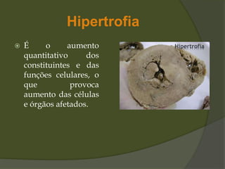 Hipertrofia
 É o aumento
quantitativo dos
constituintes e das
funções celulares, o
que provoca
aumento das células
e órgãos afetados.
 
