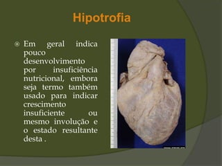 Hipotrofia
 Em geral indica
pouco
desenvolvimento
por insuficiência
nutricional, embora
seja termo também
usado para indicar
crescimento
insuficiente ou
mesmo involução e
o estado resultante
desta .
 