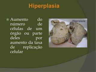 Hiperplasia
 Aumento do
número de
células de um
órgão ou parte
deles por
aumento da taxa
de replicação
celular
 