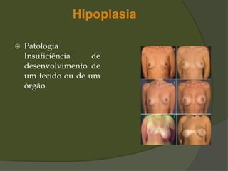 Hipoplasia
 Patologia
Insuficiência de
desenvolvimento de
um tecido ou de um
órgão.
 