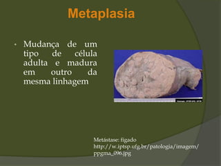 Metaplasia
• Mudança de um
tipo de célula
adulta e madura
em outro da
mesma linhagem
Metástase: fígado
http://w.iptsp.ufg.br/patologia/imagem/
ppgma_096.jpg
 