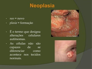 Neoplasia
• neo = novo
• plasia = formação
• É o termo que designa
alterações celulares
autônomas.
• As células não são
capazes de se
diferenciar como
acontece nos tecidos
normais.
 