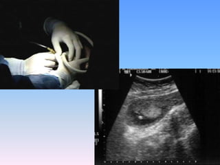 Prevención del SAMEnsayos de Amnioinfusión.1980 – 1990: la amnioinfusión para LAM de consistencia espesa mejoraron los scores de APGAR y previnieron el SAM.