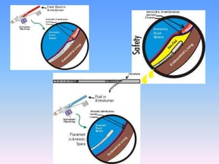 Un reciente y extenso ensayo internacional controlado y randomizado, indica que esta terapia no reduce el riesgo del SAM.