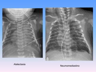 Compresión torácica: se comprime el tórax del RN y se aplica presión a fin de prevenir una inspiración profunda antes de la succión intratraqueal.