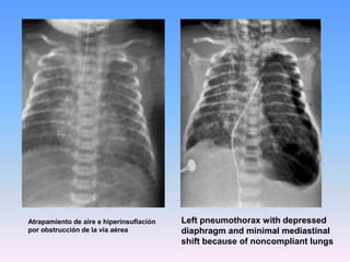  Ninguna de estas maniobras han sido científicamente validadas y todas son potencialmente peligrosas (trauma, estimulación vagal, o inducción de inhalación profunda).Prevención del SAMIntubación endotraqueal y succión intratraqueal en la sala de partos.La intubación endotraqueal no beneficia al recién nacido aparentemente vigoroso con LAM de cualquier consistencia.