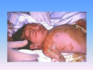 De todos los RN con SAM ,30% - 60% requieren de ventilación mecánica, 10 a 25% desarrollan neumotórax, y 2 a 5% fallecen Mientras más deprimido este el RN, mayor la ocurrencia del SAM.