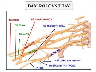 ĐÁM RỐI CÁNH TAY
 