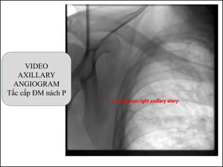 VIDEO
AXILLARY
ANGIOGRAM
Tắc cấp ĐM nách P
 