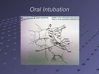 Oral IntubationOral Intubation
 