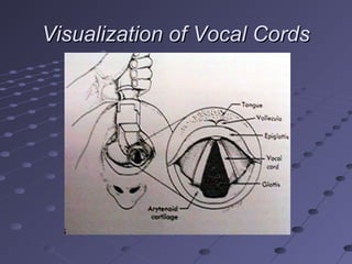 Visualization of Vocal CordsVisualization of Vocal Cords
 