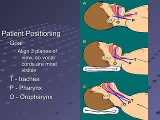 Patient PositioningPatient Positioning
GoalGoal
Align 3 planes ofAlign 3 planes of
view, so vocalview, so vocal
cords are mostcords are most
visiblevisible
T - tracheaT - trachea
P - PharynxP - Pharynx
O - OropharynxO - Oropharynx
 