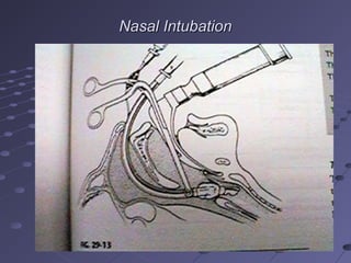Nasal IntubationNasal Intubation
 