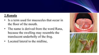 Midline Ranula salivary gland disorder.pptx