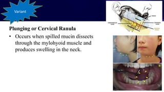 salivary gland disorder.pptx