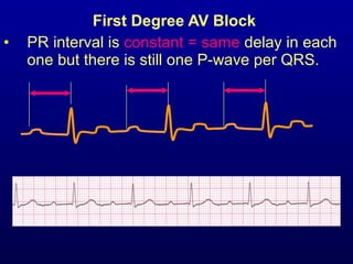 2nd part ECG basics PR interval and heart block | PPT