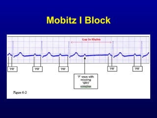 2nd part ECG basics PR interval and heart block | PPT
