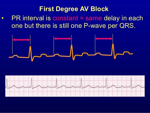 2nd Part Ecg Basics Pr Interval And Heart Block