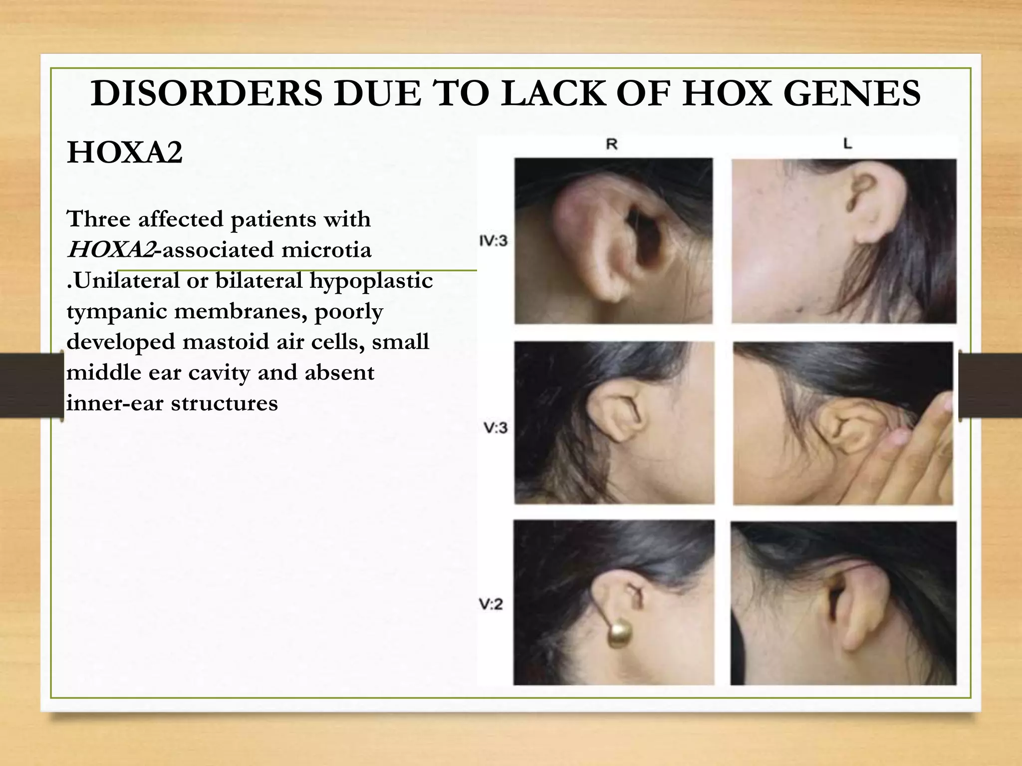 HOXA2
Three affected patients with
HOXA2-associated microtia
.Unilateral or bilateral hypoplastic
tympanic membranes, poorly
developed mastoid air cells, small
middle ear cavity and absent
inner-ear structures
DISORDERS DUE TO LACK OF HOX GENES
 
