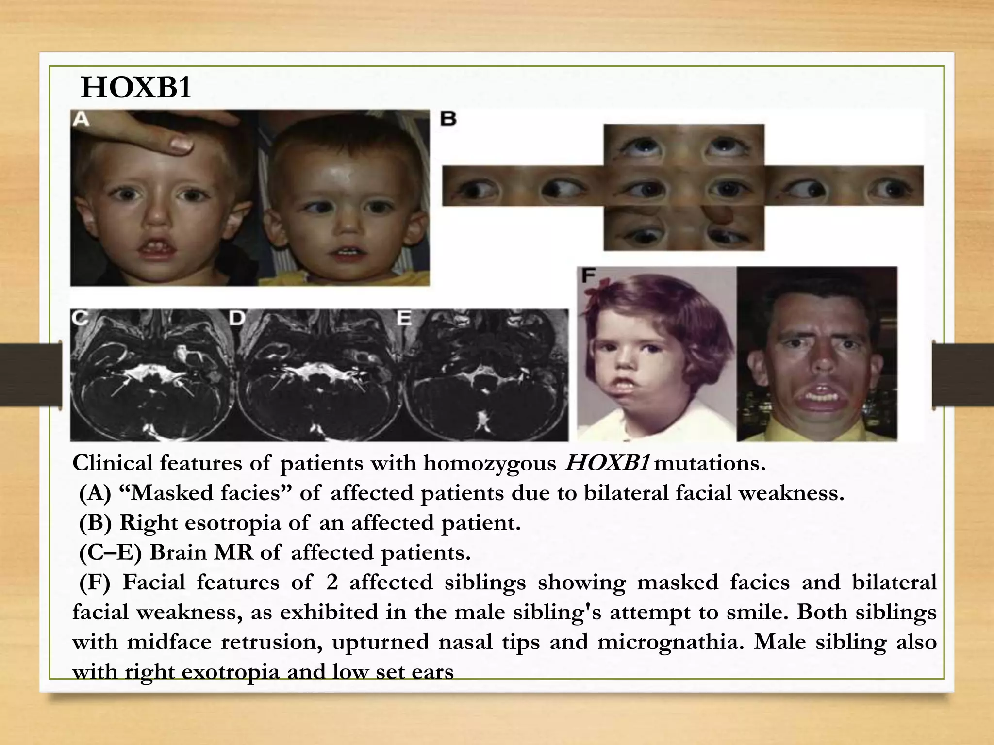 Clinical features of patients with homozygous HOXB1 mutations.
(A) “Masked facies” of affected patients due to bilateral facial weakness.
(B) Right esotropia of an affected patient.
(C–E) Brain MR of affected patients.
(F) Facial features of 2 affected siblings showing masked facies and bilateral
facial weakness, as exhibited in the male sibling's attempt to smile. Both siblings
with midface retrusion, upturned nasal tips and micrognathia. Male sibling also
with right exotropia and low set ears
HOXB1
 