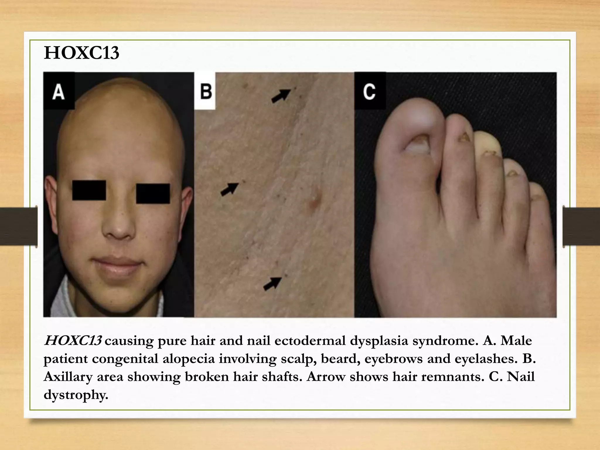 HOXC13 causing pure hair and nail ectodermal dysplasia syndrome. A. Male
patient congenital alopecia involving scalp, beard, eyebrows and eyelashes. B.
Axillary area showing broken hair shafts. Arrow shows hair remnants. C. Nail
dystrophy.
HOXC13
 