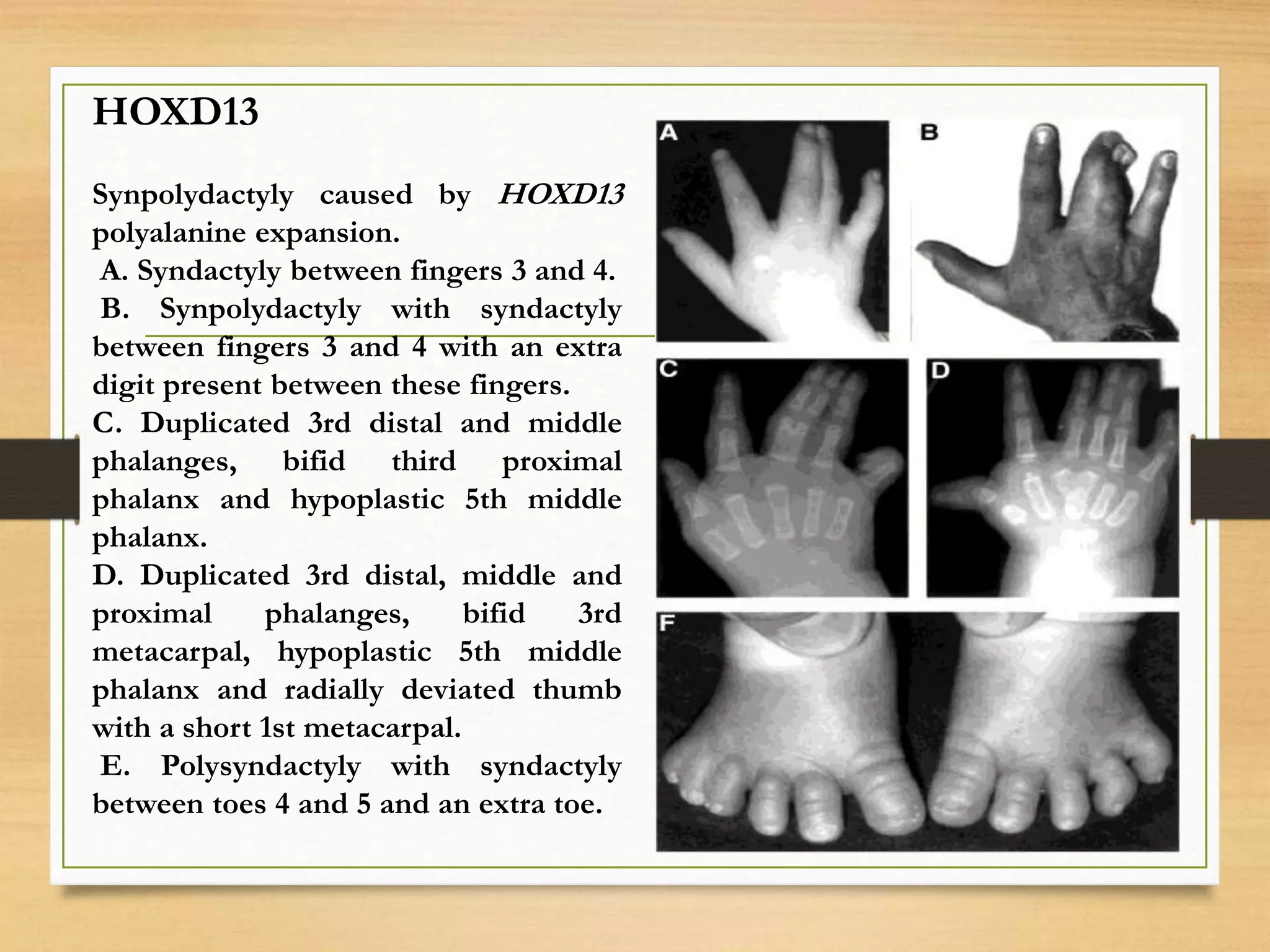 HOXD13
Synpolydactyly caused by HOXD13
polyalanine expansion.
A. Syndactyly between fingers 3 and 4.
B. Synpolydactyly with syndactyly
between fingers 3 and 4 with an extra
digit present between these fingers.
C. Duplicated 3rd distal and middle
phalanges, bifid third proximal
phalanx and hypoplastic 5th middle
phalanx.
D. Duplicated 3rd distal, middle and
proximal phalanges, bifid 3rd
metacarpal, hypoplastic 5th middle
phalanx and radially deviated thumb
with a short 1st metacarpal.
E. Polysyndactyly with syndactyly
between toes 4 and 5 and an extra toe.
 