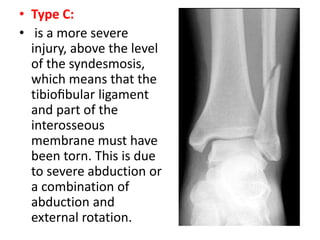• Type C:
• is a more severe
injury, above the level
of the syndesmosis,
which means that the
tibioﬁbular ligament
and part of the
interosseous
membrane must have
been torn. This is due
to severe abduction or
a combination of
abduction and
external rotation.
 