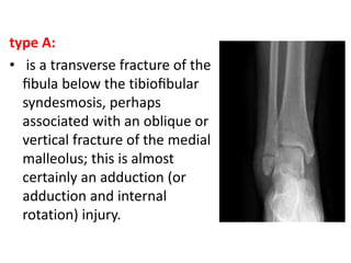 type A:
• is a transverse fracture of the
ﬁbula below the tibioﬁbular
syndesmosis, perhaps
associated with an oblique or
vertical fracture of the medial
malleolus; this is almost
certainly an adduction (or
adduction and internal
rotation) injury.
 