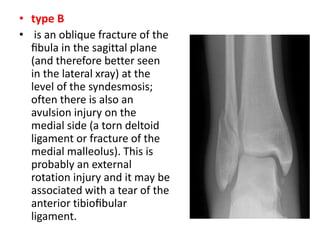 • type B
• is an oblique fracture of the
ﬁbula in the sagittal plane
(and therefore better seen
in the lateral xray) at the
level of the syndesmosis;
often there is also an
avulsion injury on the
medial side (a torn deltoid
ligament or fracture of the
medial malleolus). This is
probably an external
rotation injury and it may be
associated with a tear of the
anterior tibioﬁbular
ligament.
 