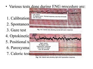 Vestibular function tests | PPTX