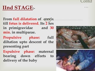 
Contd
…IInd STAGE:-
From full dilatation of cervix
till fetus is delivered. Its 2 hrs
in primigravidae and 30
min. in multiparae.
Propulsive phase: full
diltation upto descent of the
presenting part
Expulsive phase: maternal
bearing down efforts to
delivery of the baby
 