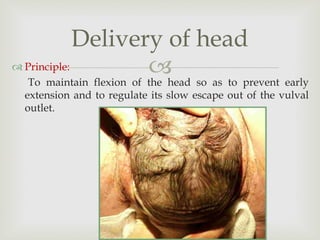  Principle:
To maintain flexion of the head so as to prevent early
extension and to regulate its slow escape out of the vulval
outlet.
Delivery of head
 