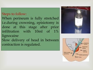
Steps to follow:
When perineum is fully stretched
i.e.during crowning, episiotomy is
done at this stage after prior
infiltration with 10ml of 1%
lignocaine
Slow delivery of head in between
contraction is regulated.
 