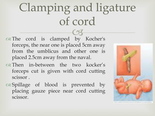  The cord is clamped by Kocher's
forceps, the near one is placed 5cm away
from the umblicus and other one is
placed 2.5cm away from the naval.
 Then in-between the two kocker’s
forceps cut is given with cord cutting
scissor .
 Spillage of blood is prevented by
placing gauze piece near cord cutting
scissor.
Clamping and ligature
of cord
 
