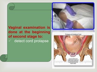 
Vaginal examination is
done at the beginning
of second stage to:
 detect cord prolapse
 