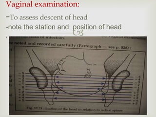 
Vaginal examination:
-To assess descent of head
-note the station and position of head
,
 