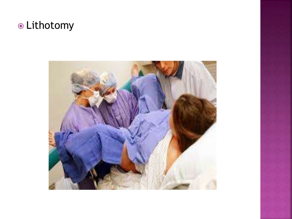 NURSING MANAGEMENT OF SECOND STAGE OF LABOUR