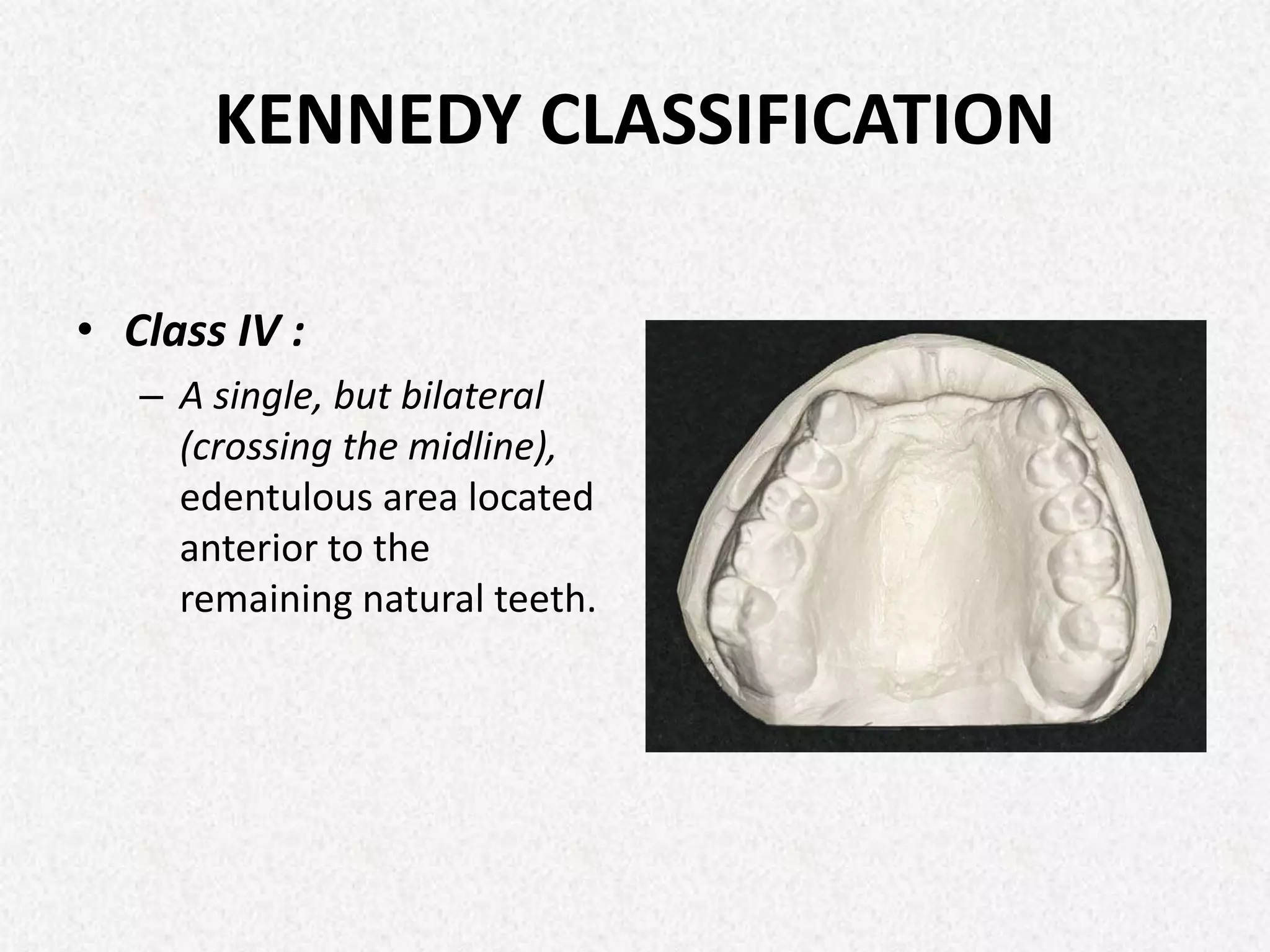 2nd year pre clinical RPD Terminology, Components and Classification of ...