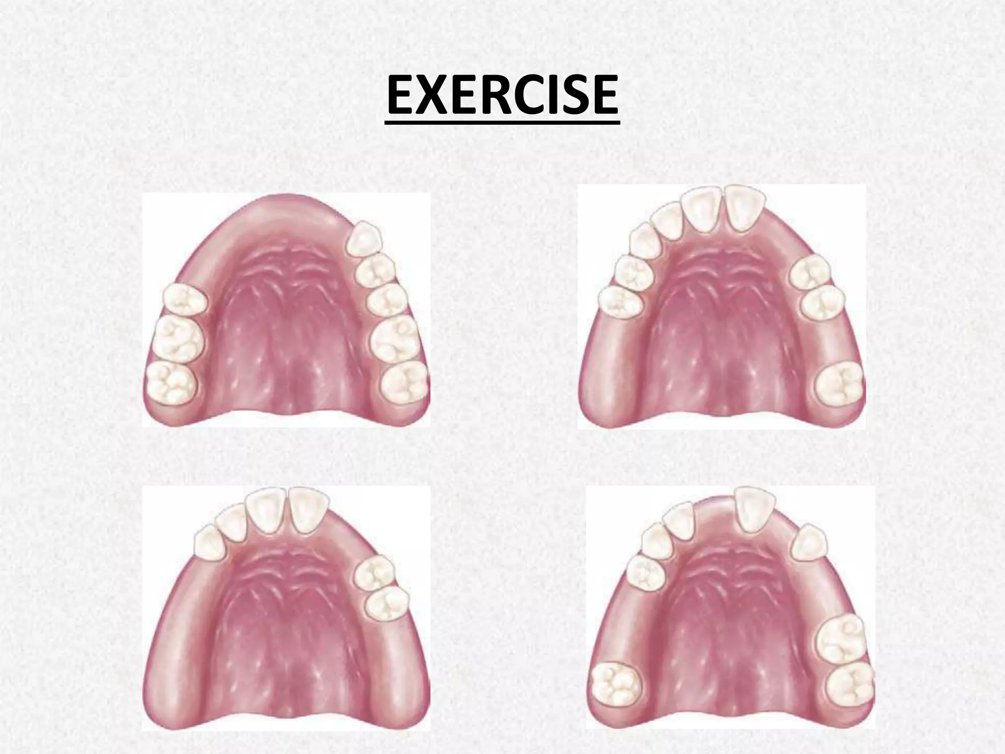 Rpd Pre Rendered 2nd year pre clinical RPD Terminology, Components and Classification of ...
